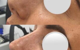 Non surgical rhinoplasty derry/londonderry