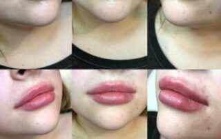 Lip Fillers, Cosmetic Injections, Dermal Fillers