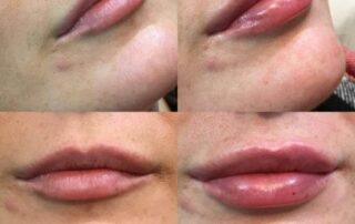 before and after natural lip fillers
