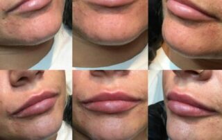 Fineline Clinical lip filler treatment