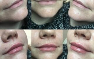 Before and after lips fillers derry