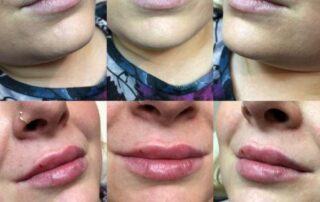 Natural lip filler treatments