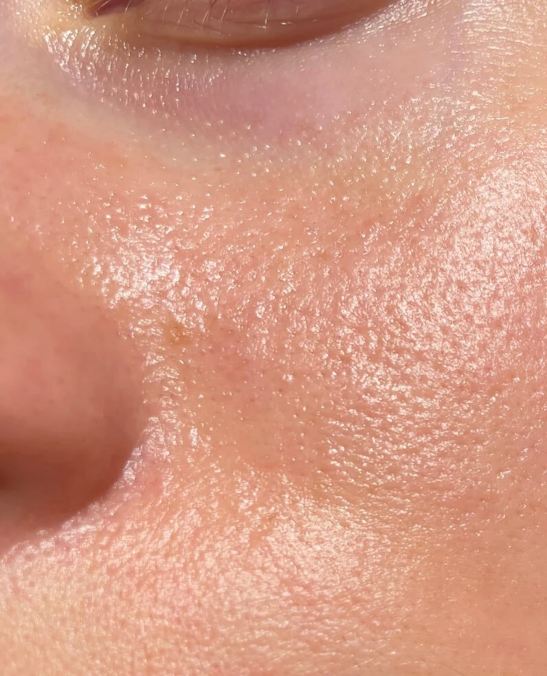 derma-stamp