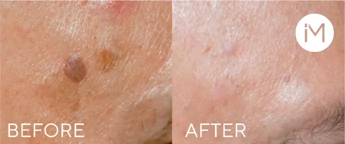 AVAILABLE_lesions1