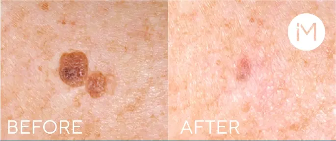 AVAILABLE_lesions3